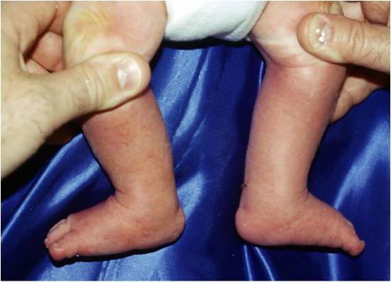 lonkka dysplasia lapsella