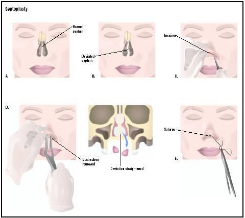 nenän septumkorjaus laserilla