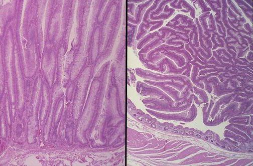 tubulaarinen adenoma, jonka dysplasia on 1 2 astetta